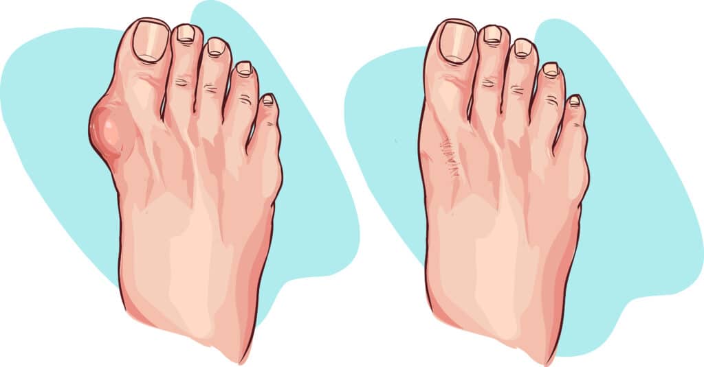 Illustration of foot with and without a bunion on a blue and white backdrop
