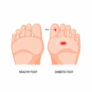 Diabetic Foot Care Nashville TN - CE Foot & Ankle Clinic, Nashville