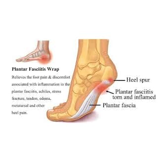 Plantar Fasciitis: A Painful Heel - Hughston Clinic