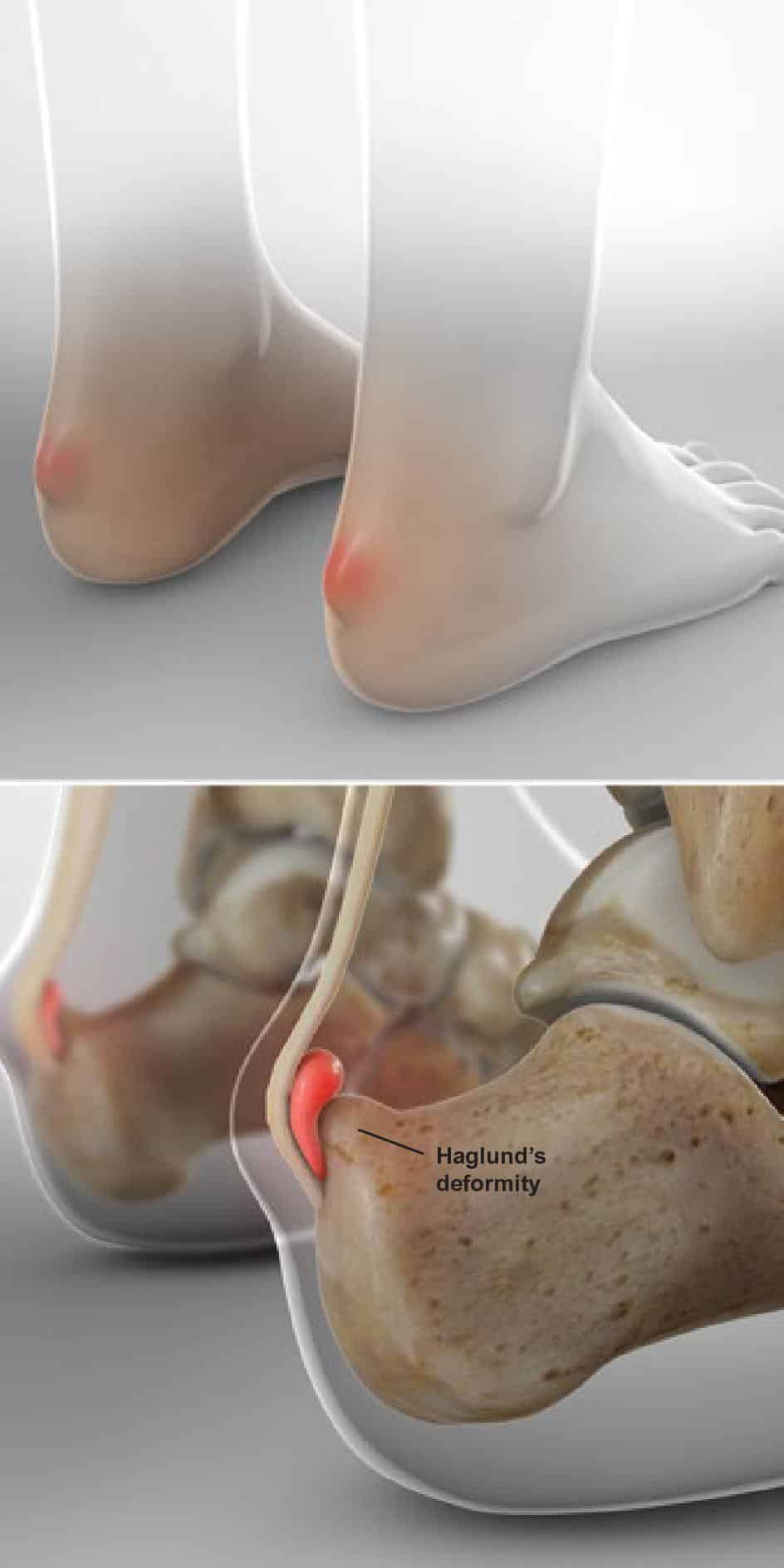 Haglunds Deformity Pump Bump Ce Foot And Ankle Clinic Nashville 8876