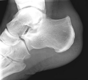 Haglunds Deformity Pump Bump Ce Foot Ankle Clinic Nashville