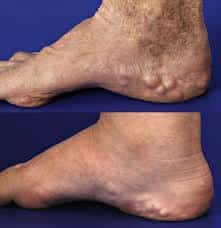 image of heel with pedal papules