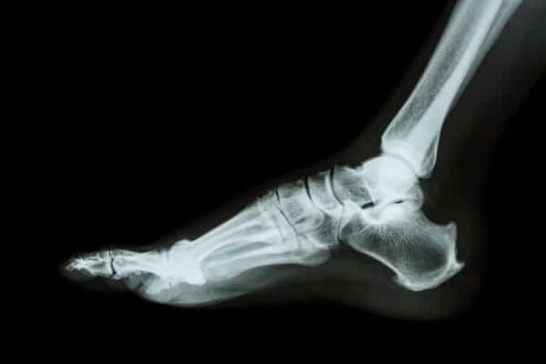 X-ray normal foot lateral
