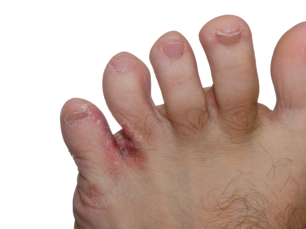Close up of foot fungus between a man's toes isolated on white